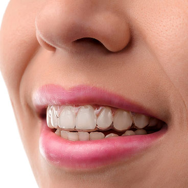 Invisalign on patient's teeth