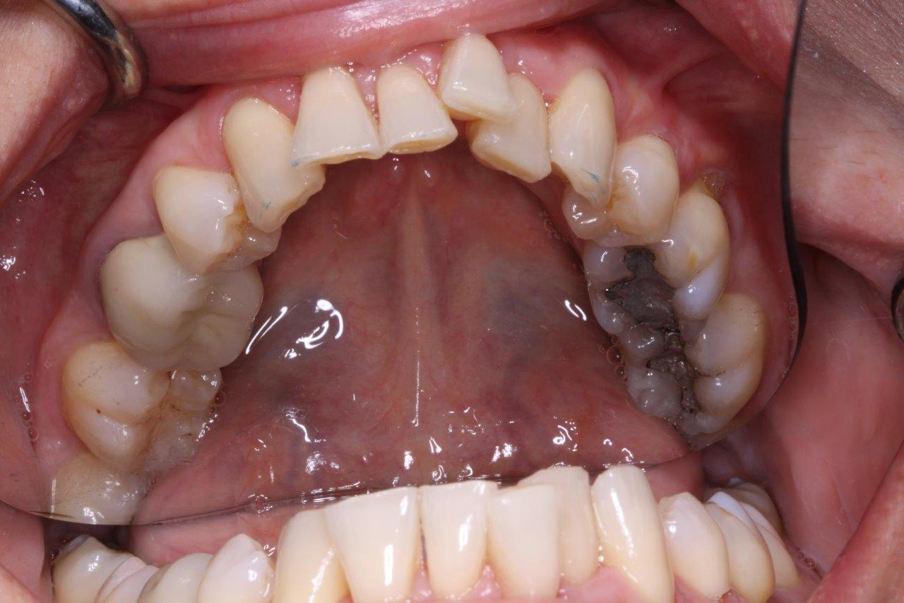 Invisalign before