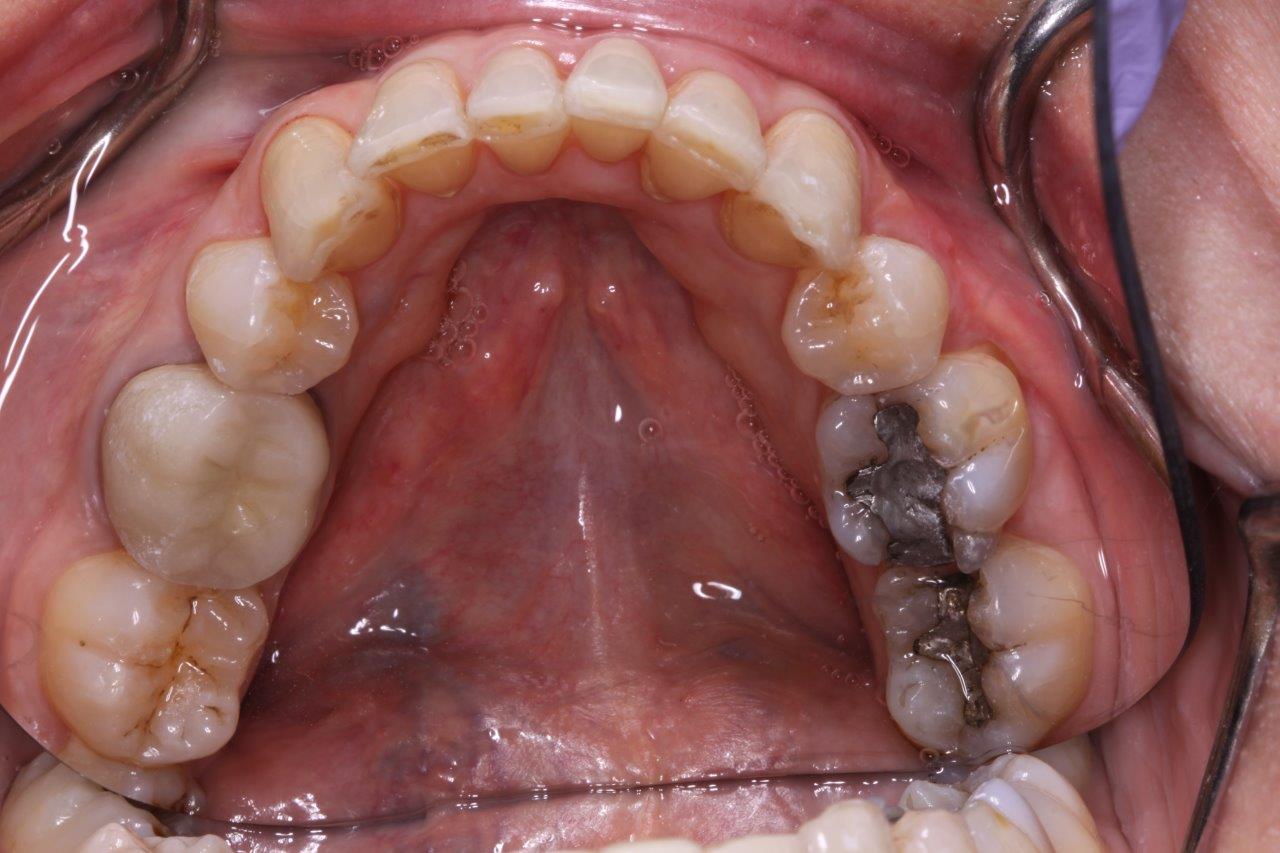 Invisalign after