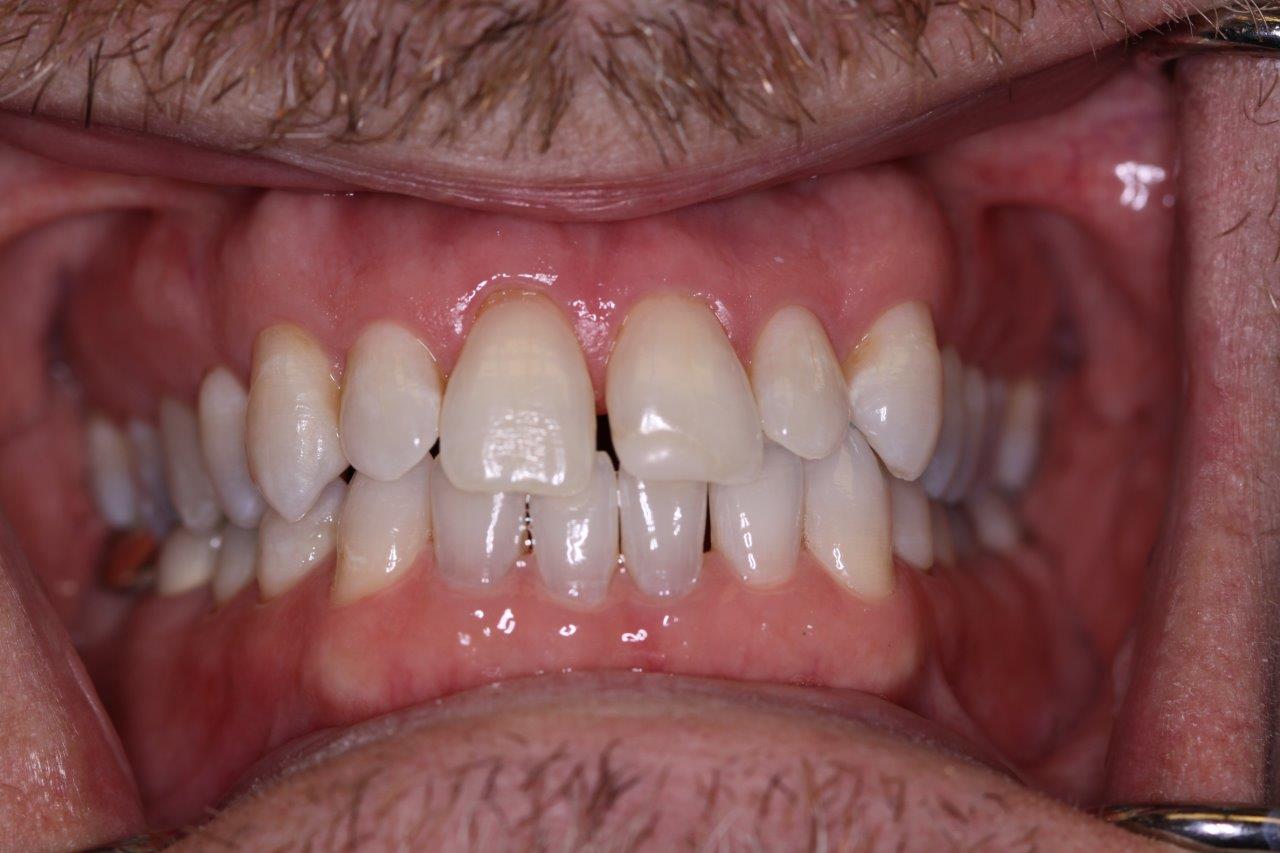 Invisalign before