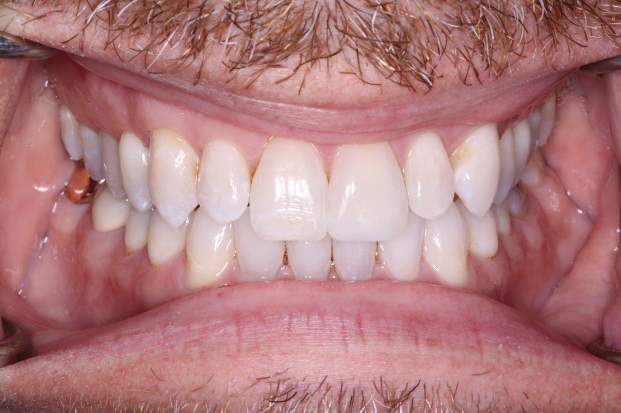 Invisalign after