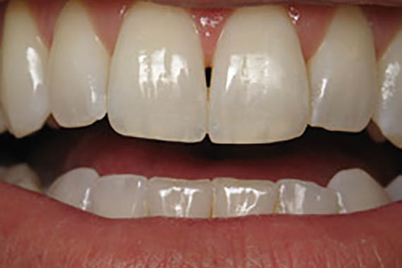 cosmetic bonding after