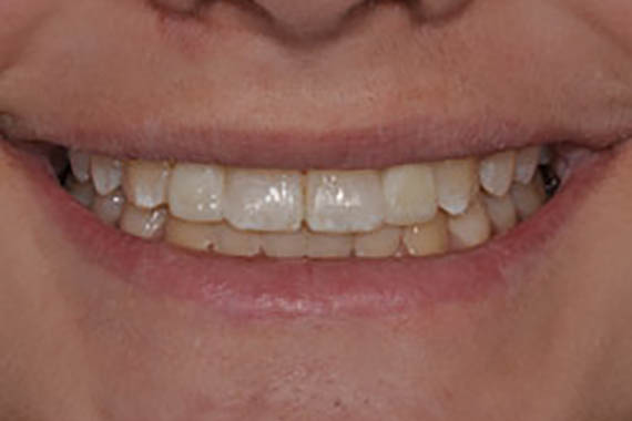 implant crown after