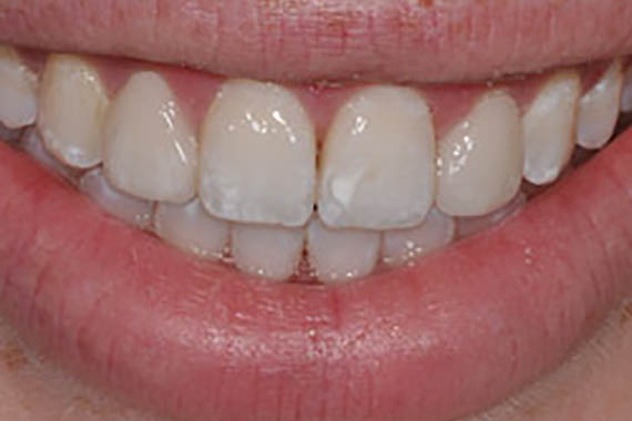 veneers after