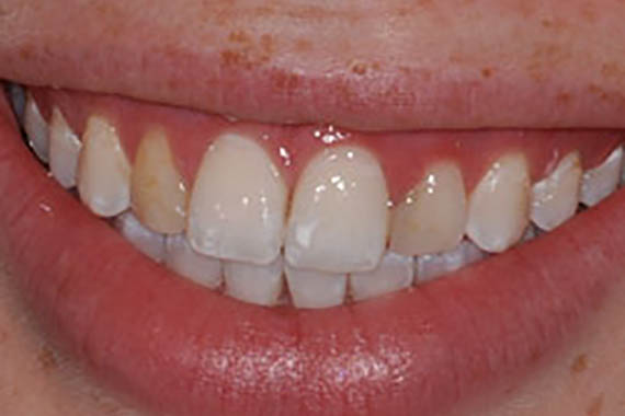 veneers before