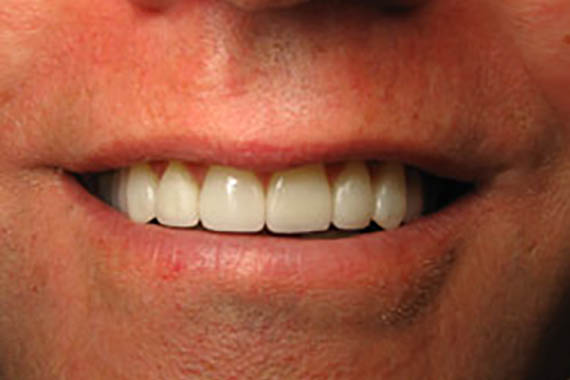 veneers after