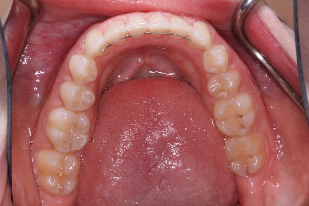 invisalign after