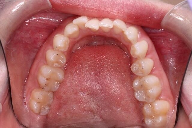 invisalign before