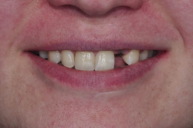 invisalign before