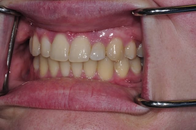 invisalign after