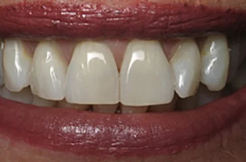 Contouring-after Contouring-after