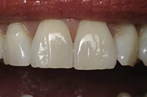 Contouring-before Contouring-before