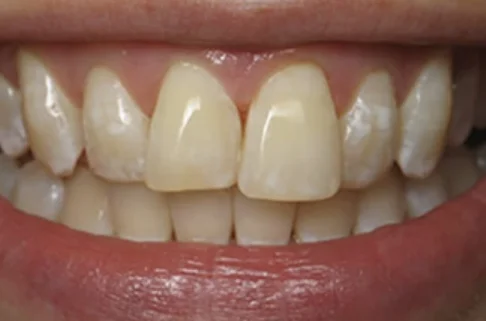 Cosmetic Bonding-after Cosmetic Bonding-after