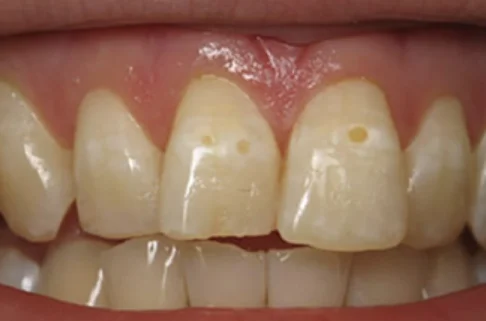 Cosmetic Bonding-before Cosmetic Bonding-before