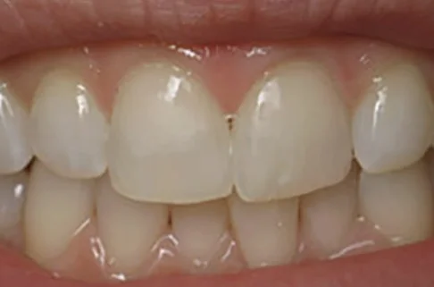 Cosmetic Bonding2-after Cosmetic Bonding2-after