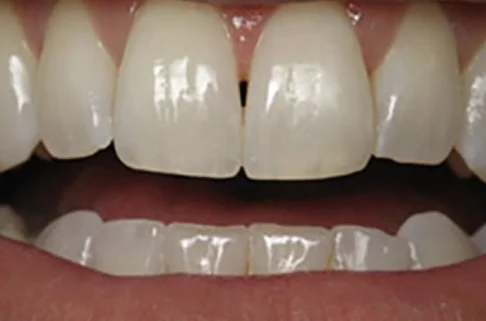 Cosmetic Bonding3-after Cosmetic Bonding3-after