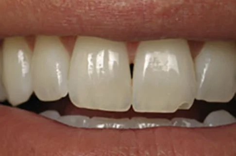 Cosmetic Bonding4-after Cosmetic Bonding4-after