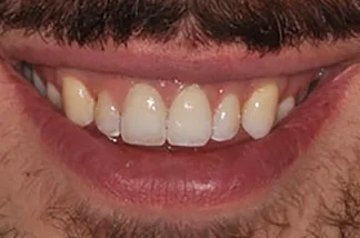 Crowns-after Crowns-after