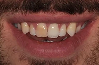 Crowns-before Crowns-before