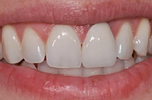 Crowns2-after Crowns2-after