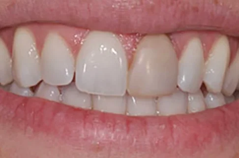 Crowns2-before Crowns2-before