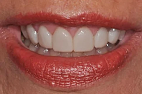 Crowns3-after Crowns3-after