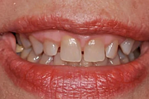 Crowns3-before Crowns3-before