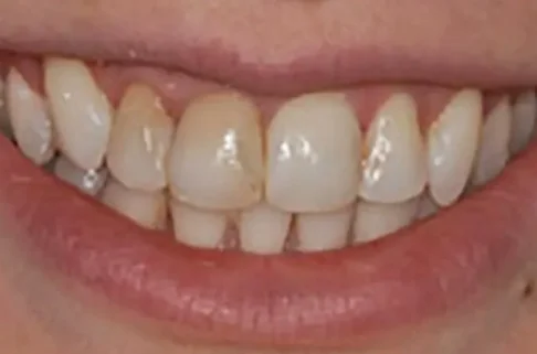 Crowns4-before Crowns4-before