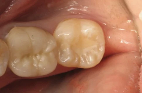 Filling-after Filling-after