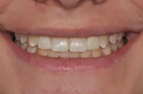 Implants-Implant Restoration-after Implants-Implant Restoration-after