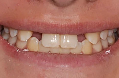 Implants-Implant Restoration-before Implants-Implant Restoration-before