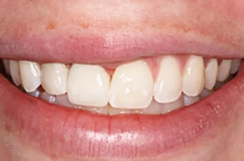 Implants-Implant Restoration2-after Implants-Implant Restoration2-after