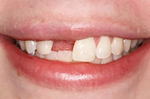 Implants-Implant Restoration2-before Implants-Implant Restoration2-before