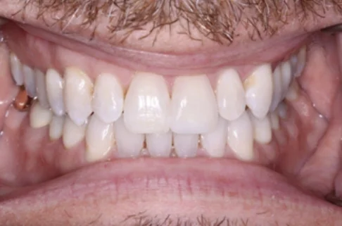 Invisalign2-after Invisalign2-after