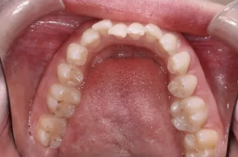 Invisalign3-before Invisalign3-before