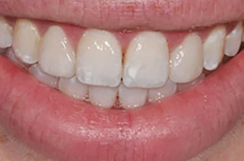 Veneers-after Veneers-after