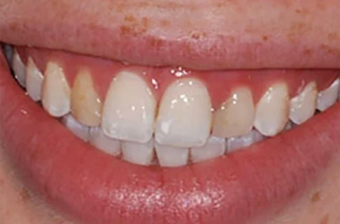 Veneers-before Veneers-before
