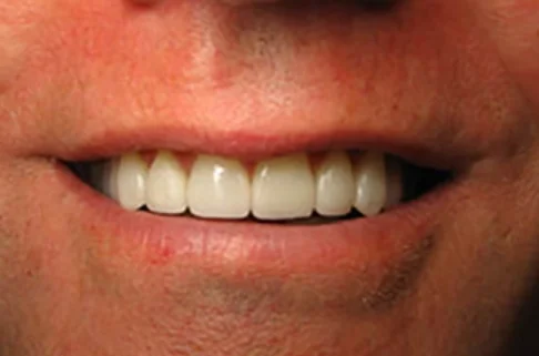 Veneers2-after Veneers2-after