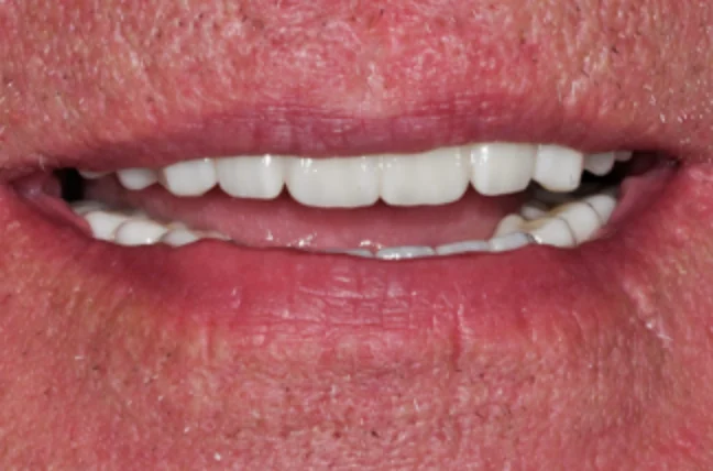 Implant-Hybrid-denture-after
