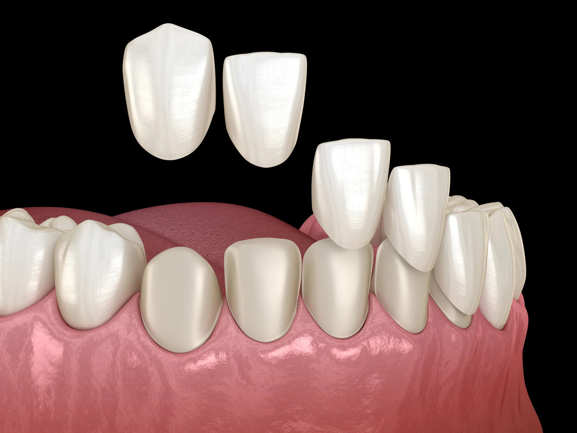 Porcelain Restorations
