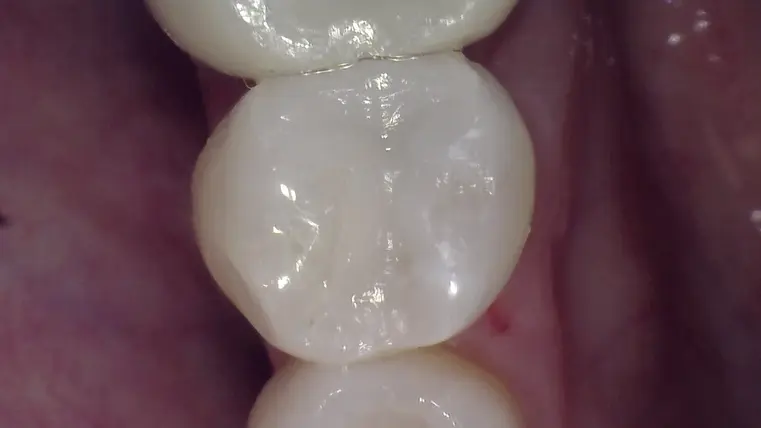 Amalgam-filling_After