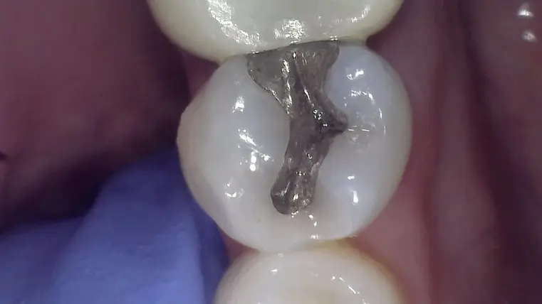 Amalgam-filling_Before