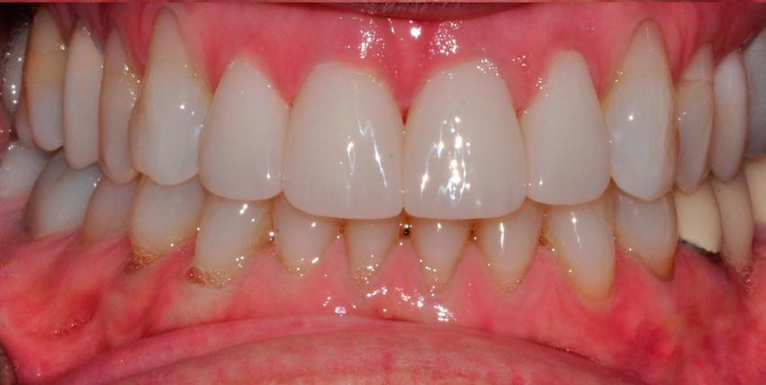 anterior-crown-after