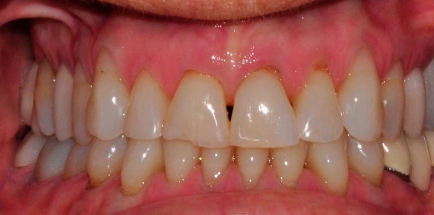 anterior-crown-before