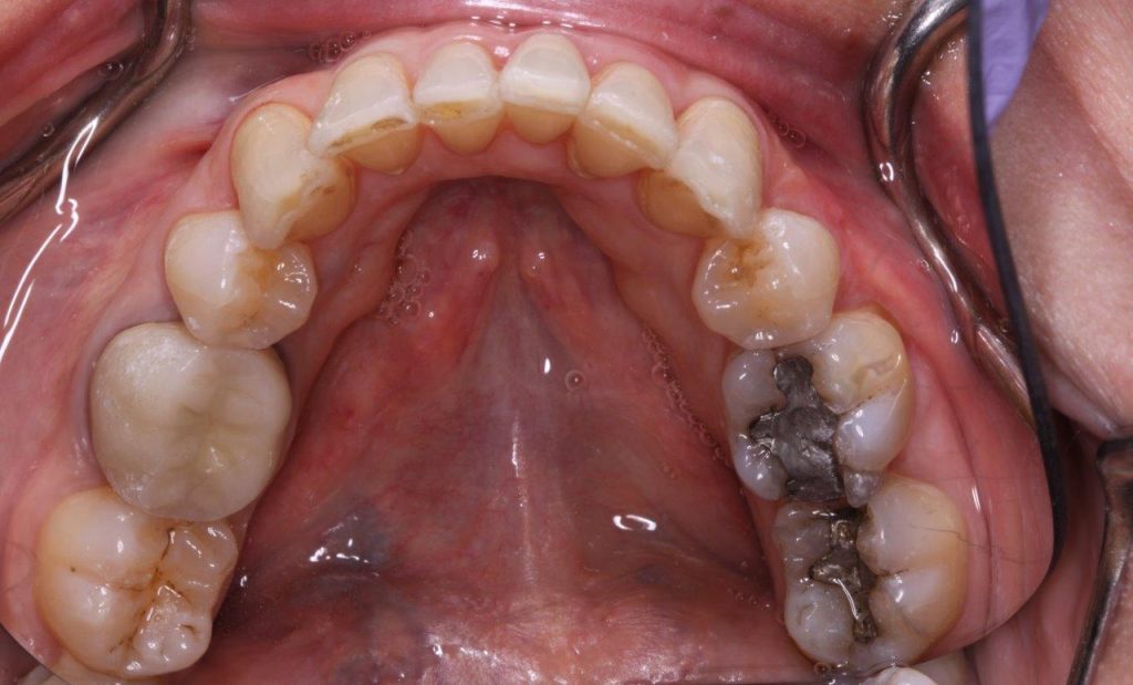 Invisalign-after