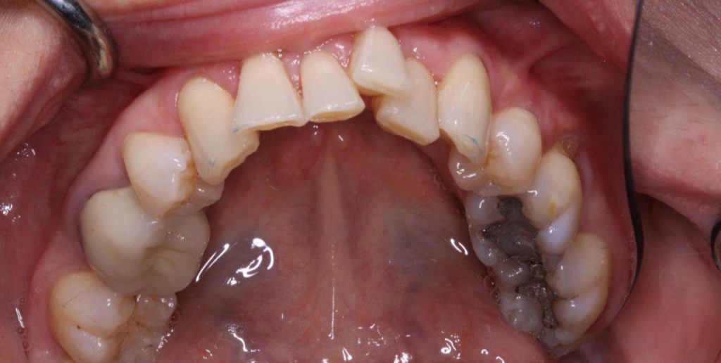 Invisalign-before