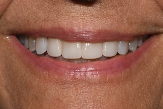 After - Dr. Renshaw, Crowns #7-#10