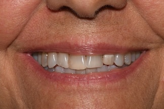 Before - Dr. Renshaw, Crowns #7-#10